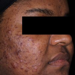 AviClear Before & After Patient #1671